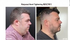 Resultados antes y después de tensado de bandas platisma en VG Plastic Surgery, lifting visible