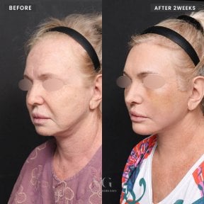 Resultados de lifting facial antes y después en VG Plastic Surgery – rejuvenecimiento facial tras 2 semanas