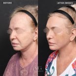 Resultados de lifting facial antes y después en VG Plastic Surgery – rejuvenecimiento facial tras 2 semanas