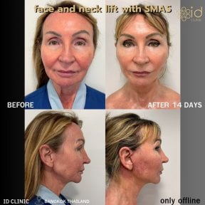 Before and after facelift with SMAS at ID Clinic Bangkok, visible face and neck lift results