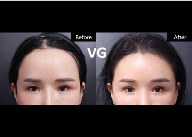 Vorher-nachher-Ergebnis der Blepharoplastik bei VG Plastic Surgery, Lidkorrektur