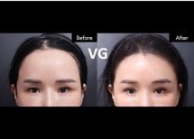 Vorher-nachher-Ergebnis der Blepharoplastik bei VG Plastic Surgery, Lidkorrektur