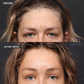 Blepharoplastik Vorher-Nachher-Ergebnis bei VG Plastic Surgery, Lidkorrektur nach 1 Woche