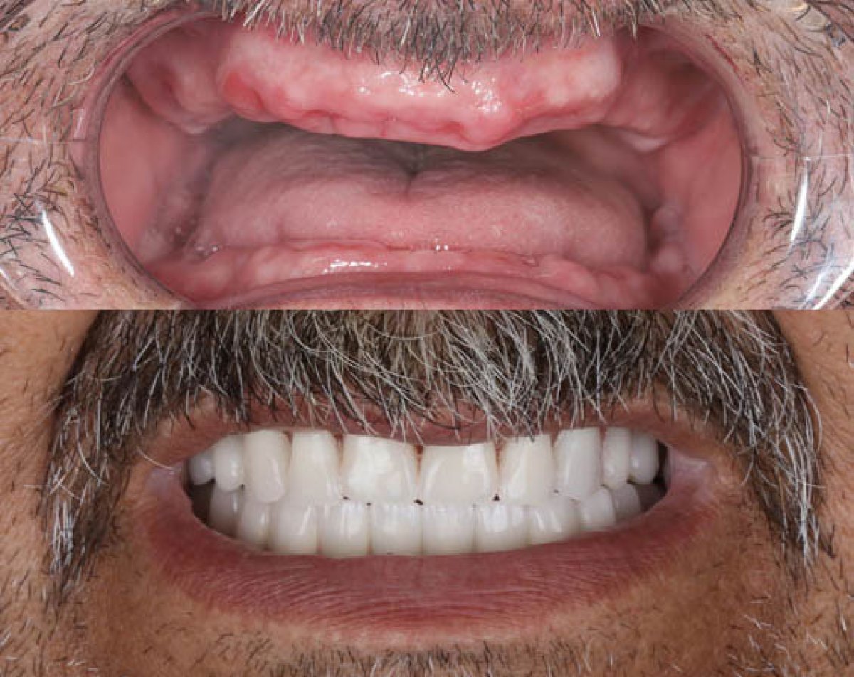 Resultados antes y después de implantes dentales All-on-4: restauración total de la sonrisa