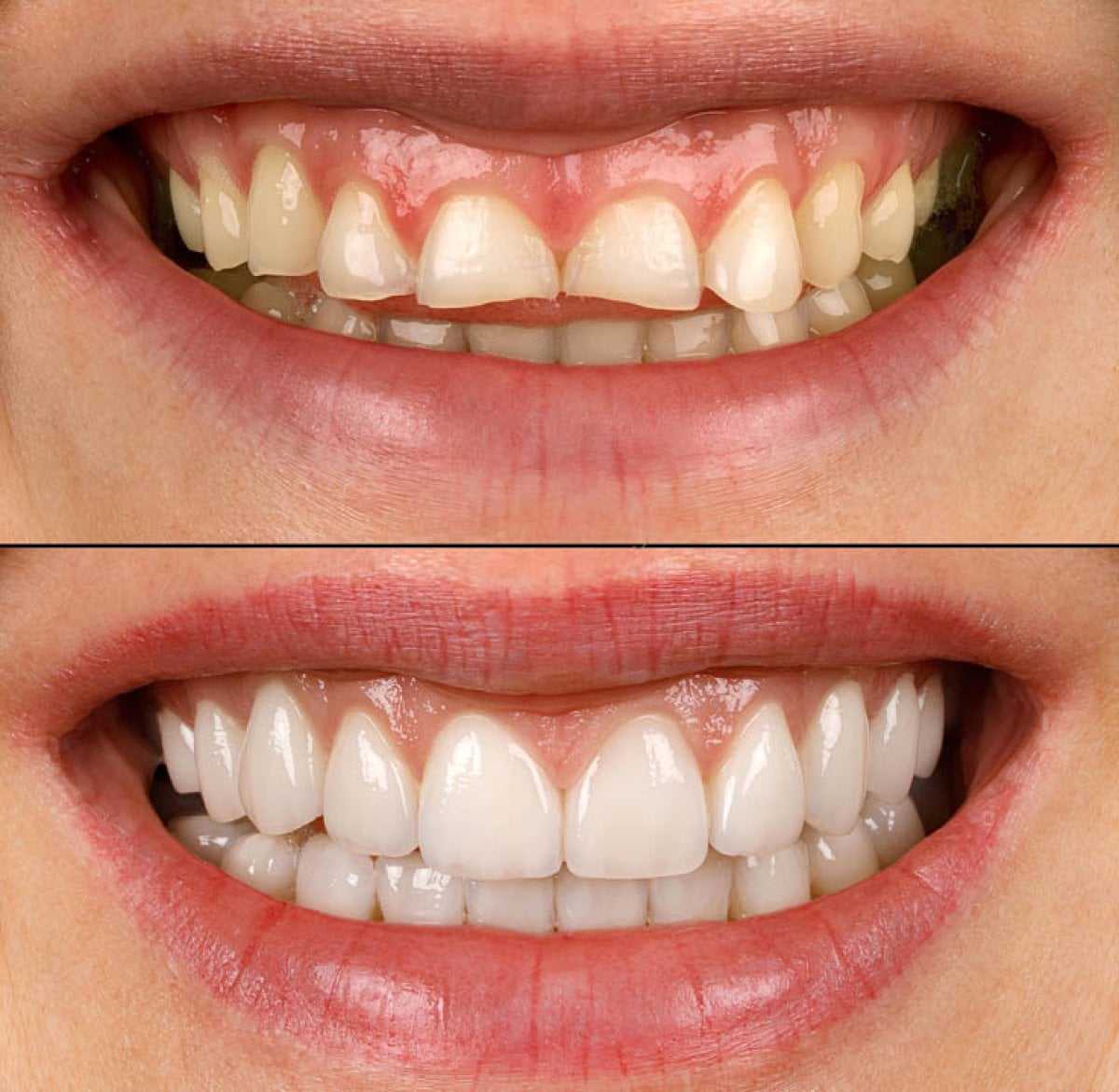 Resultados antes y después de coronas dentales: mejora estética y forma de los dientes