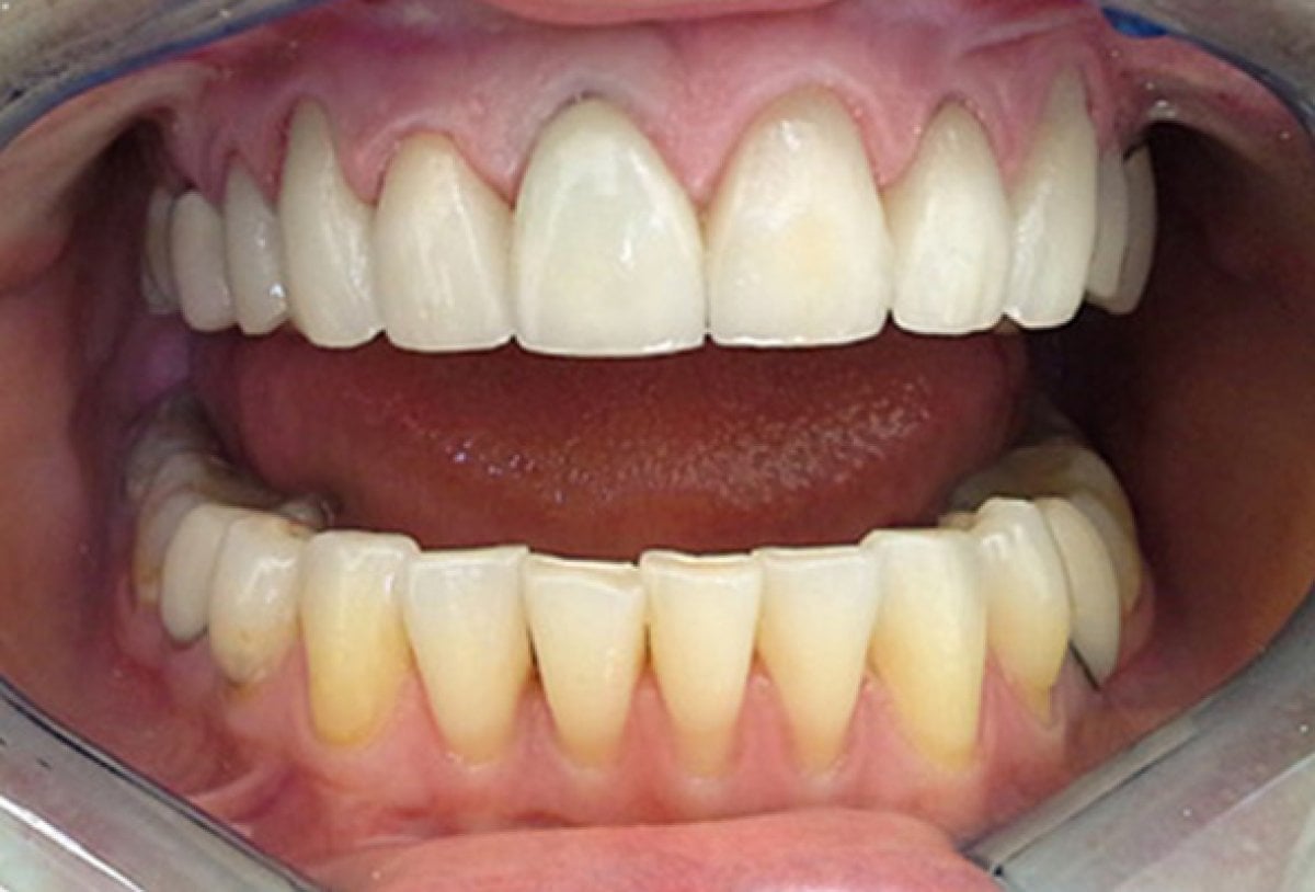 Resultados antes y después de limpieza dental – blanqueamiento y eliminación de placa
