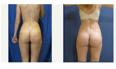 before-after photo buttock-implants