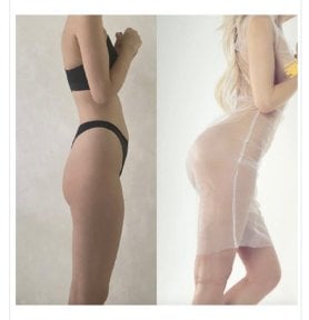 before-after photo buttock-implants
