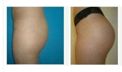 before-after photo buttock-implants