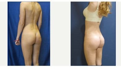 before-after photo buttock-implants