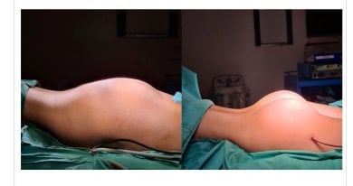before-after photo buttock-implants