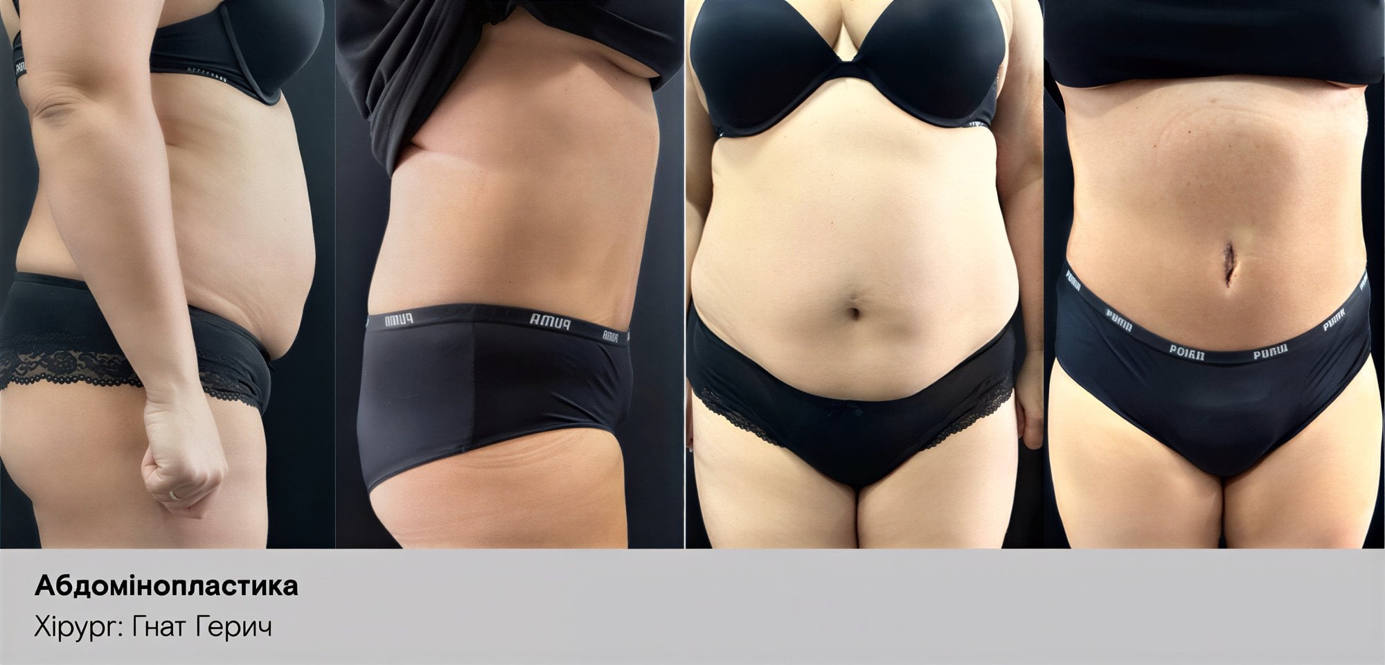 Resultados de abdominoplastia antes y después, mejora visible del contorno abdominal