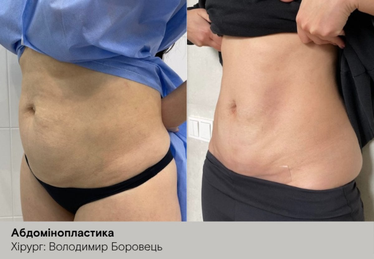 Resultados de abdominoplastia antes y después, mejora visible del contorno abdominal