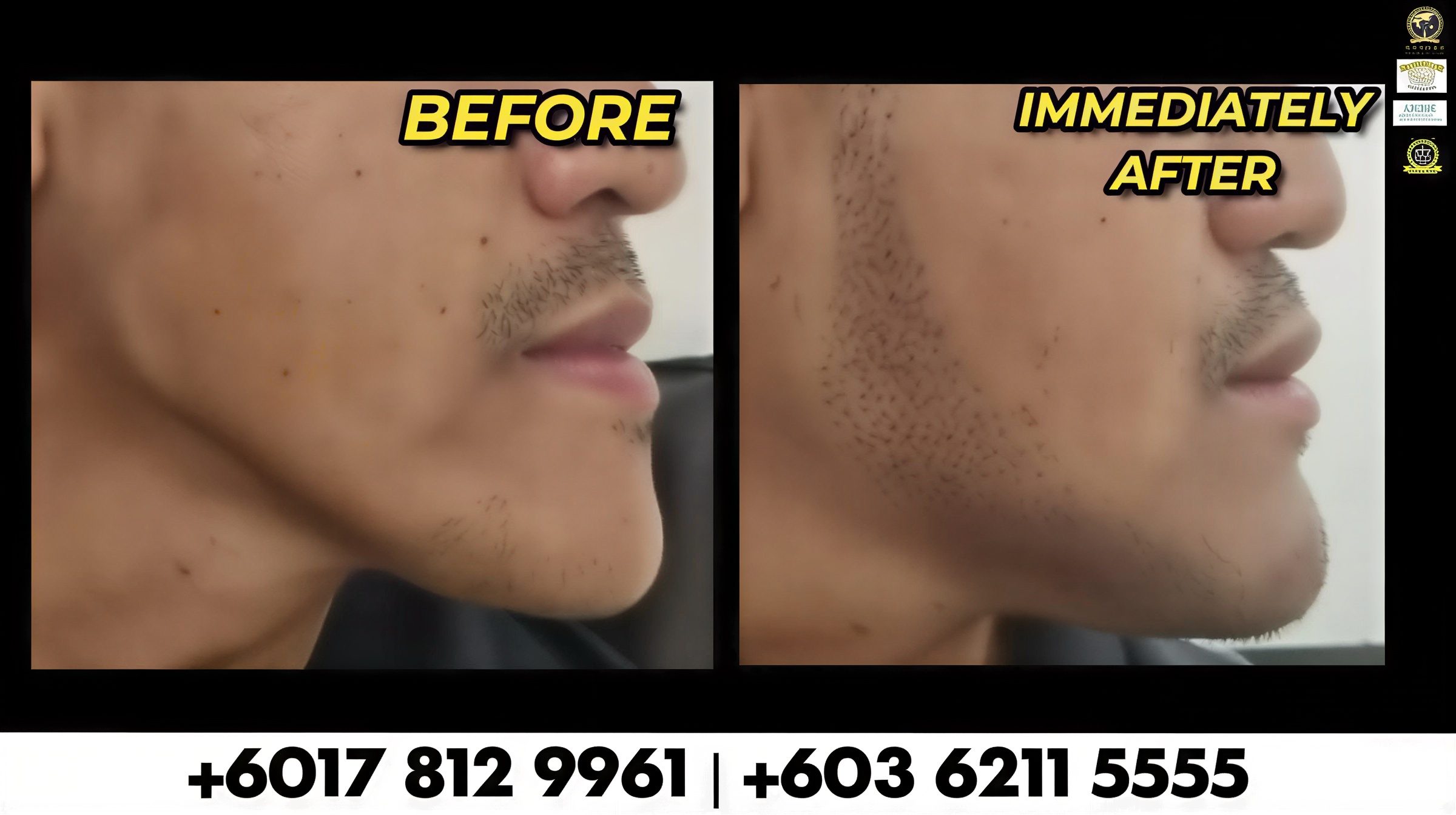 Resultados de trasplante de barba antes y después, mayor densidad y contorno facial