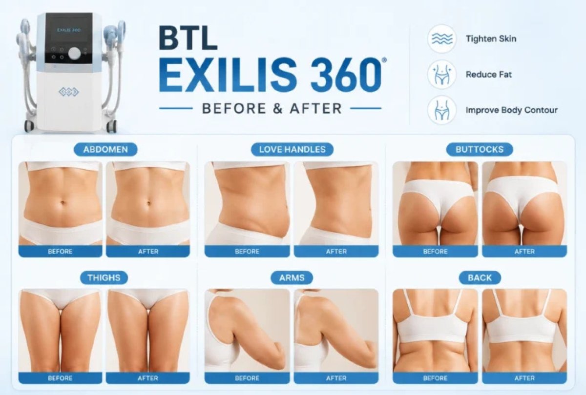 Resultados antes y después de BTL Exilis 360 en abdomen, muslos, brazos, espalda, glúteos, flancos