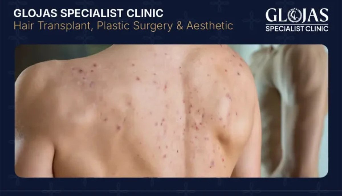 Resultado de terapia medicamentosa para acné en Glojas Specialist Clinic – mejora en la espalda