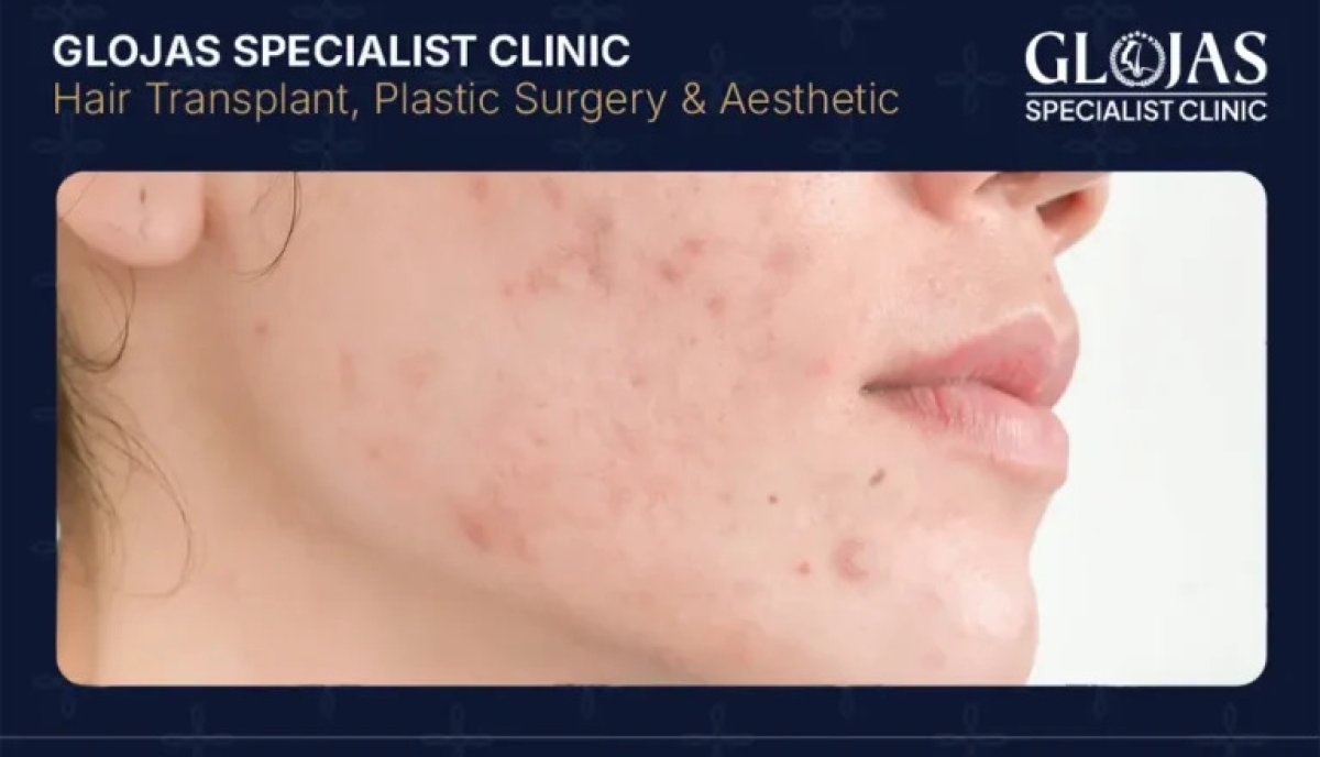 Resultado de terapia medicamentosa para acné en Glojas Specialist Clinic, mejora facial visible
