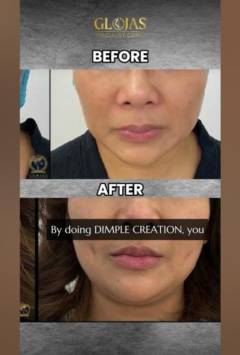 Resultados antes y después de cirugía de hoyuelos en Glojas Specialist Clinic, mejillas realzadas