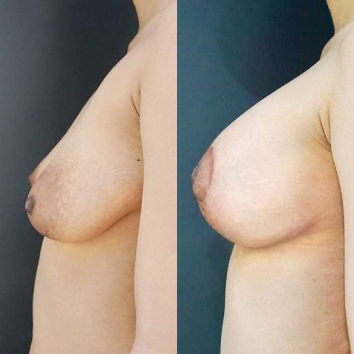 Resultados antes y después de lifting de senos en Cosmacare Clinic Center for Aesthetic Medicine and Plastic Surgery