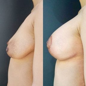before-after photo mastopexy-breast-lift-contour-plastics