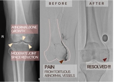 before-after photo genicular-artery-embolization