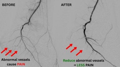 before-after photo transarterial-microembolization-tame