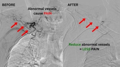 before-after photo transarterial-microembolization-tame