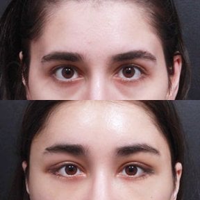 before-after photo fox-eye-surgery