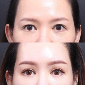 before-after photo fox-eye-surgery
