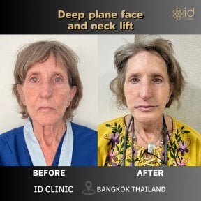 before-after photo tightening-of-facial-skin-facelift