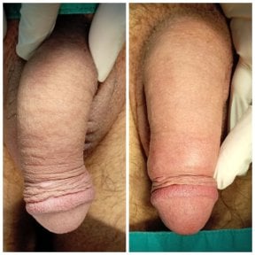 before-after photo penis-enlargement