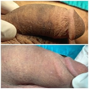 before-after photo penis-enlargement