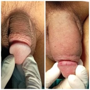 before-after photo penis-enlargement