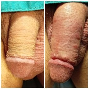 before-after photo penis-enlargement