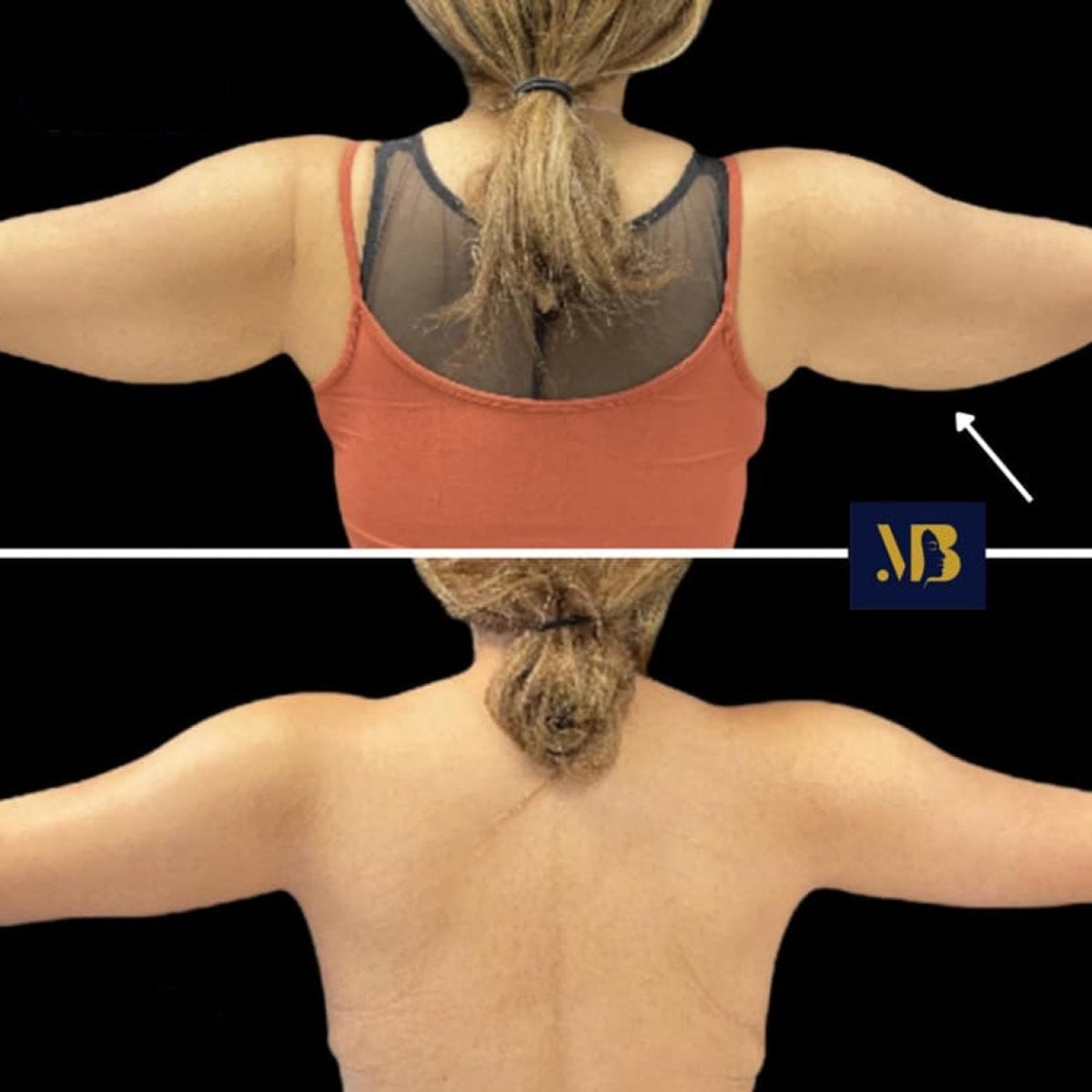 Resultados antes y después de lifting de brazos en Michaël Benoilid Plastic and Cosmetic Surgeon Paris France