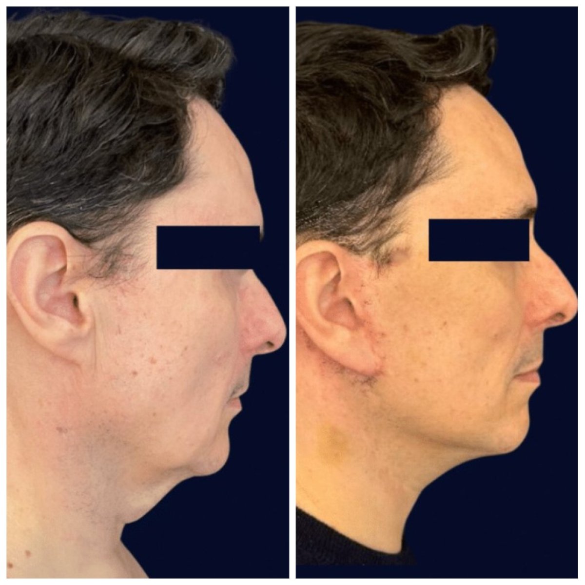 نتائج شد الوجه قبل وبعد في Michaël Benoilid Plastic and Cosmetic Surgeon Paris France