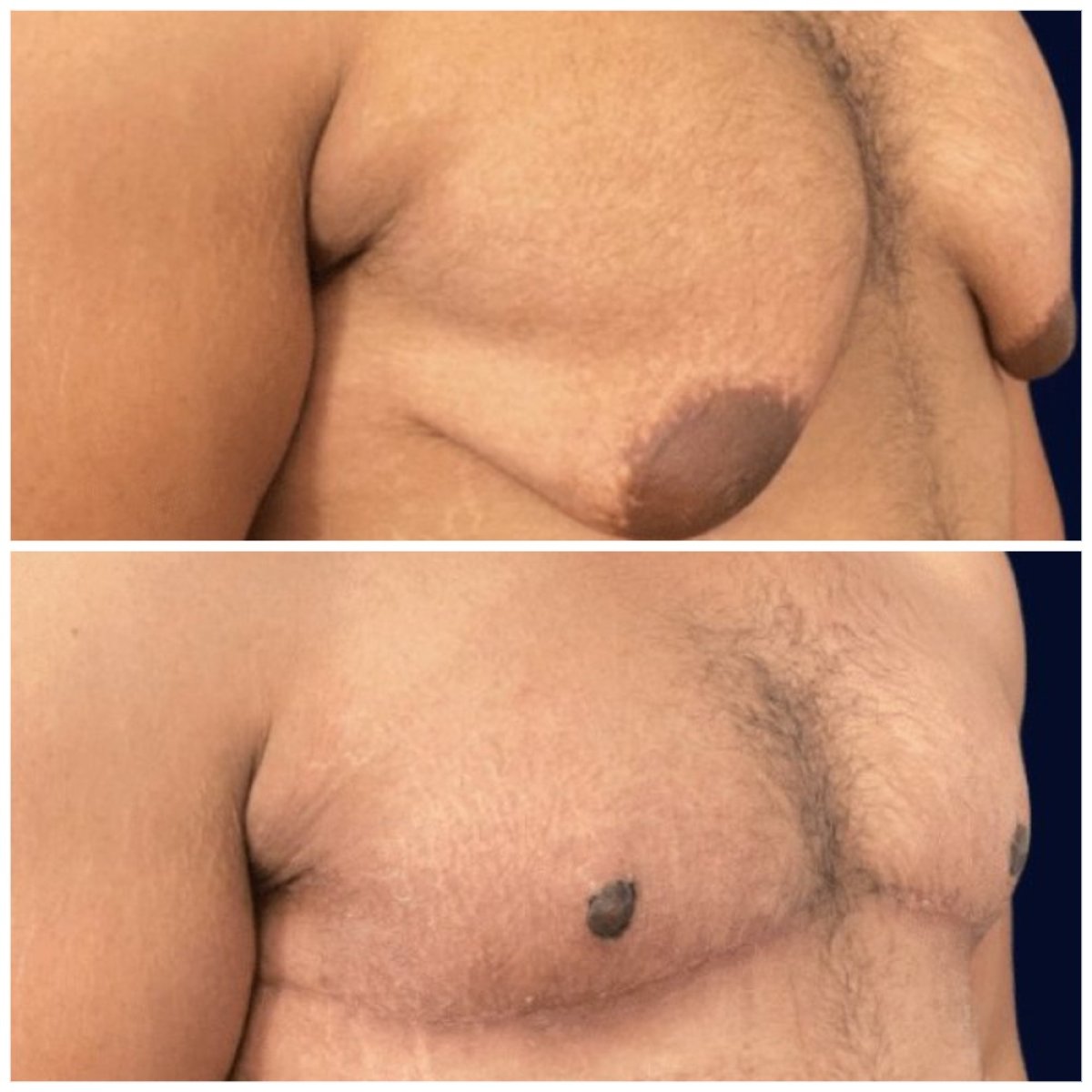 نتائج قبل وبعد جراحة التثدي في Michaël Benoilid Plastic and Cosmetic Surgeon Paris