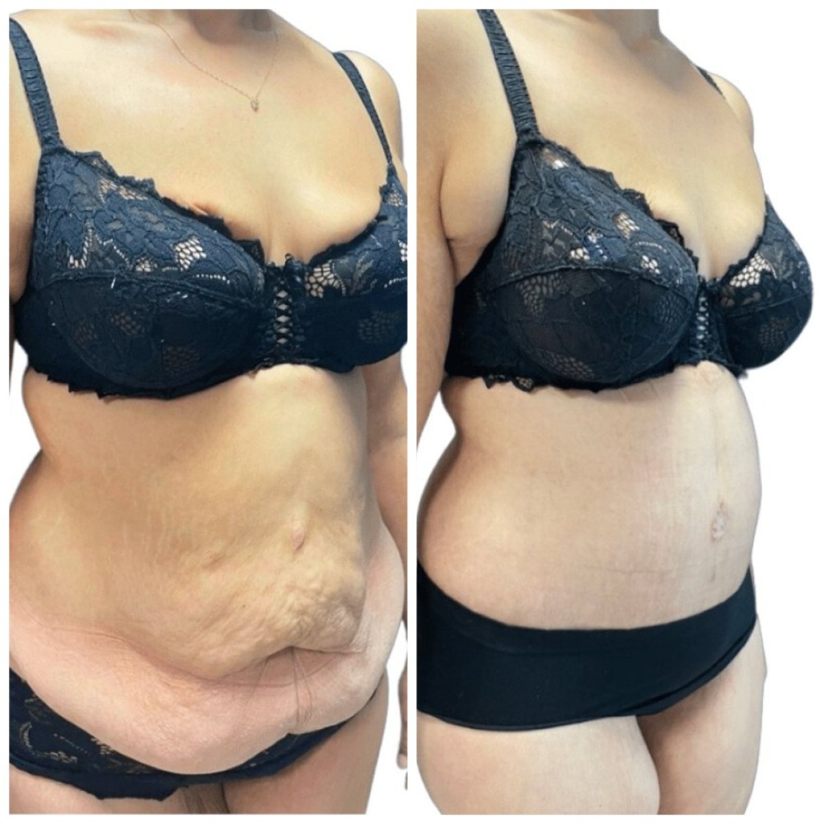 Resultados de abdominoplastia antes y después en Michaël Benoilid Plastic and Cosmetic Surgeon París