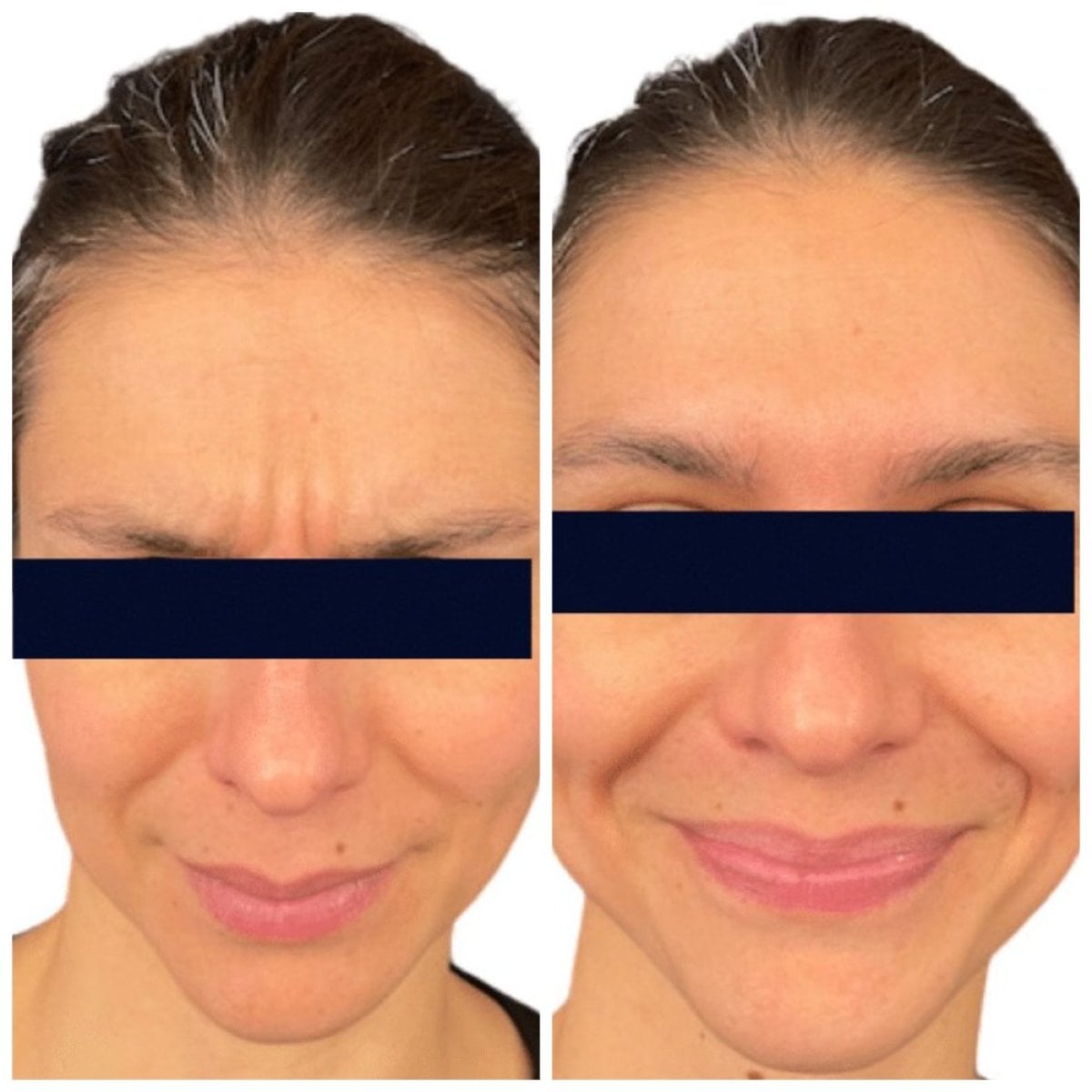 نتائج قبل وبعد حقن البوتوكس في عيادة Michaël Benoilid Plastic and Cosmetic Surgeon Paris France