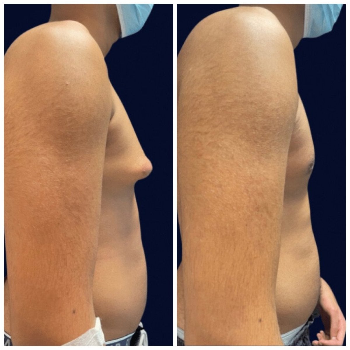 Resultados antes y después de cirugía de ginecomastia en Michaël Benoilid Plastic Surgeon Paris France