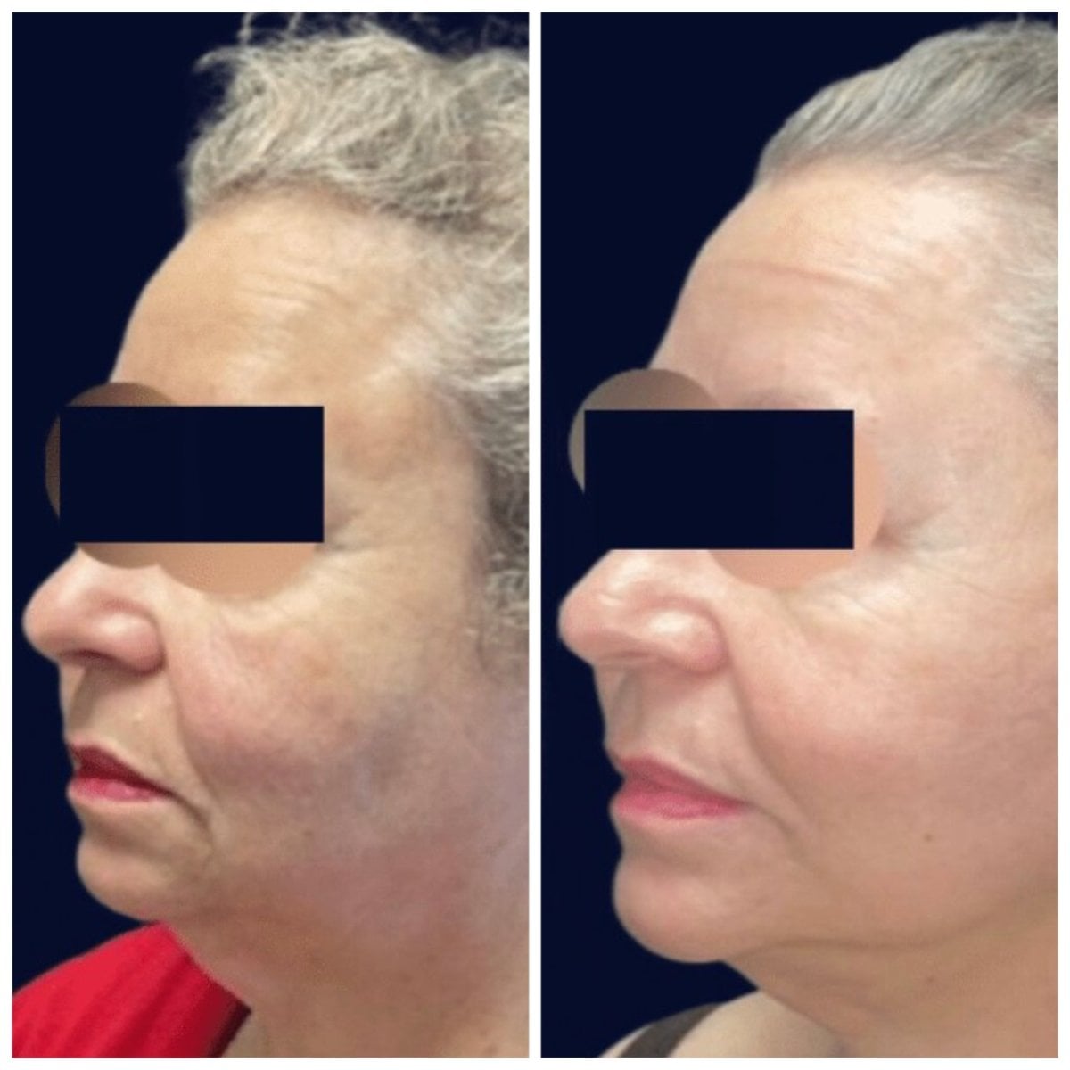 Resultados de lifting facial antes y después en Michaël Benoilid Plastic and Cosmetic Surgeon París
