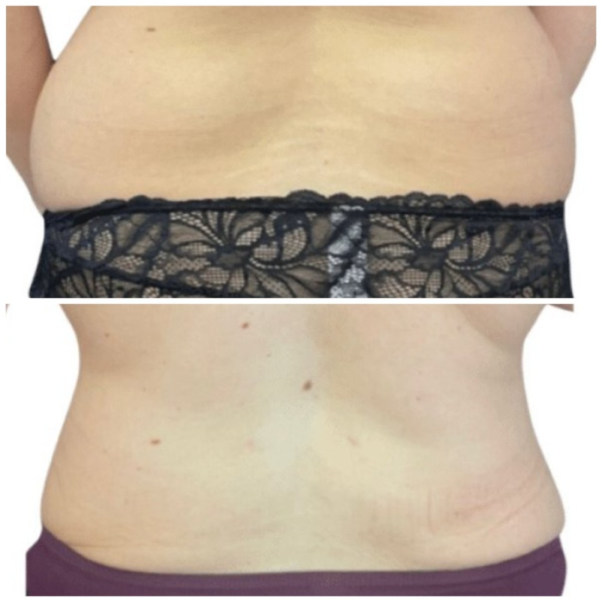 نتائج شفط الدهون قبل وبعد في Michaël Benoilid Plastic and Cosmetic Surgeon Paris France