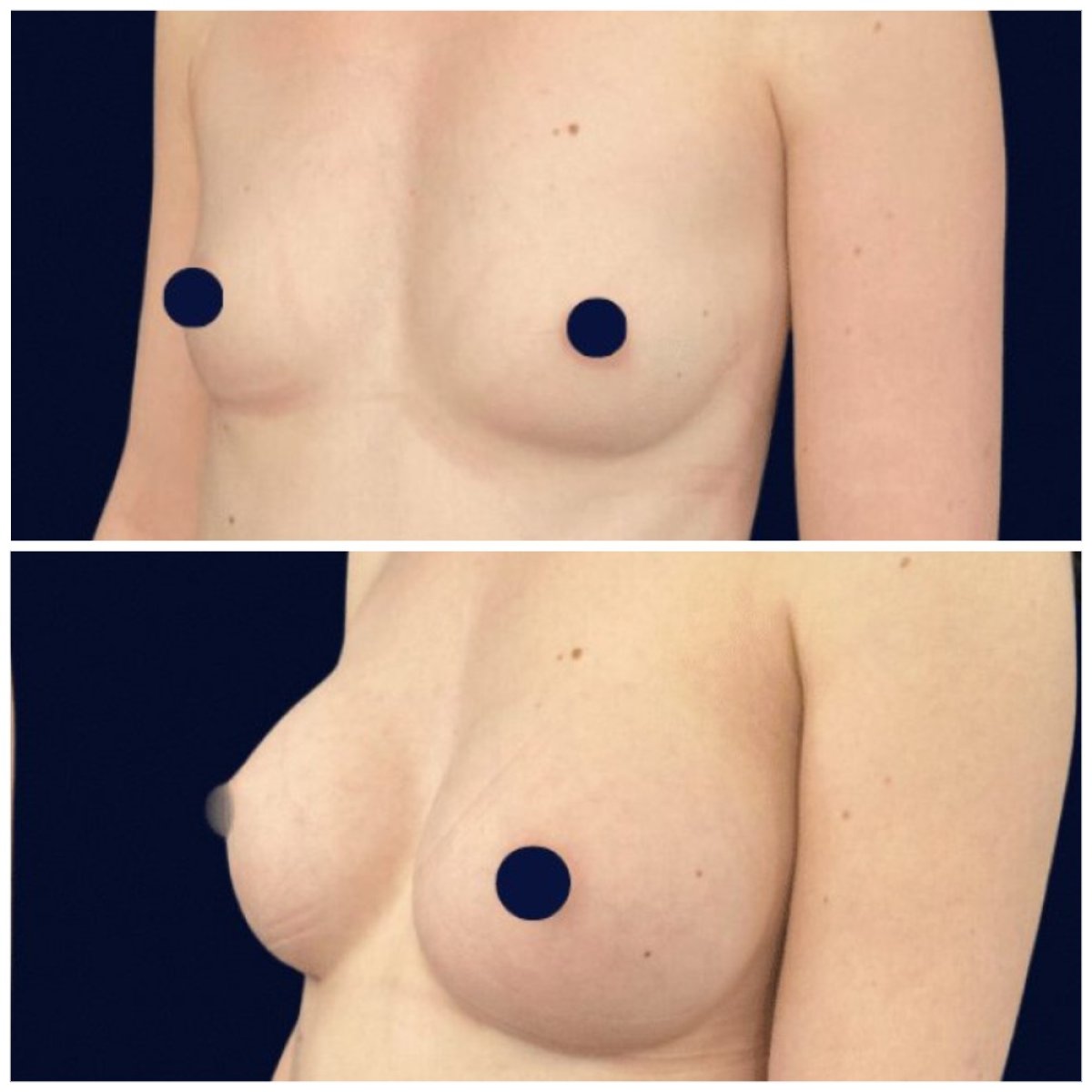 Resultados antes y después de aumento de senos en Michaël Benoilid Plastic and Cosmetic Surgeon Paris