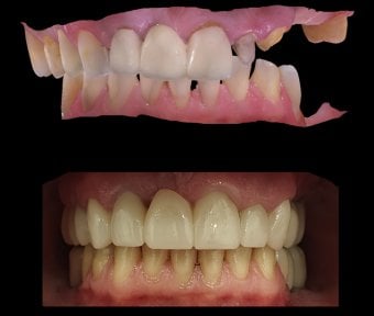 before-after photo zirconia-crown-installation