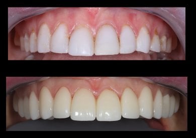 before-after photo zirconia-crown-installation