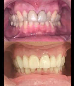 before-after photo zirconia-crown-installation