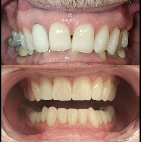 before-after photo zirconia-crown-installation