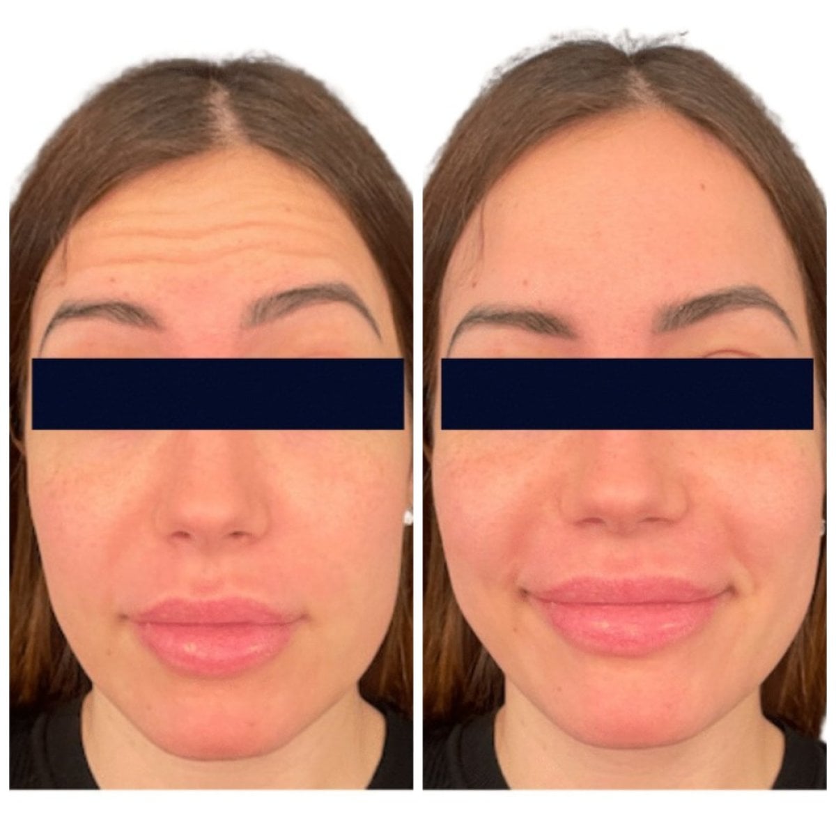 Resultados antes y después de inyecciones de bótox en Michaël Benoilid Plastic and Cosmetic Surgeon Paris France