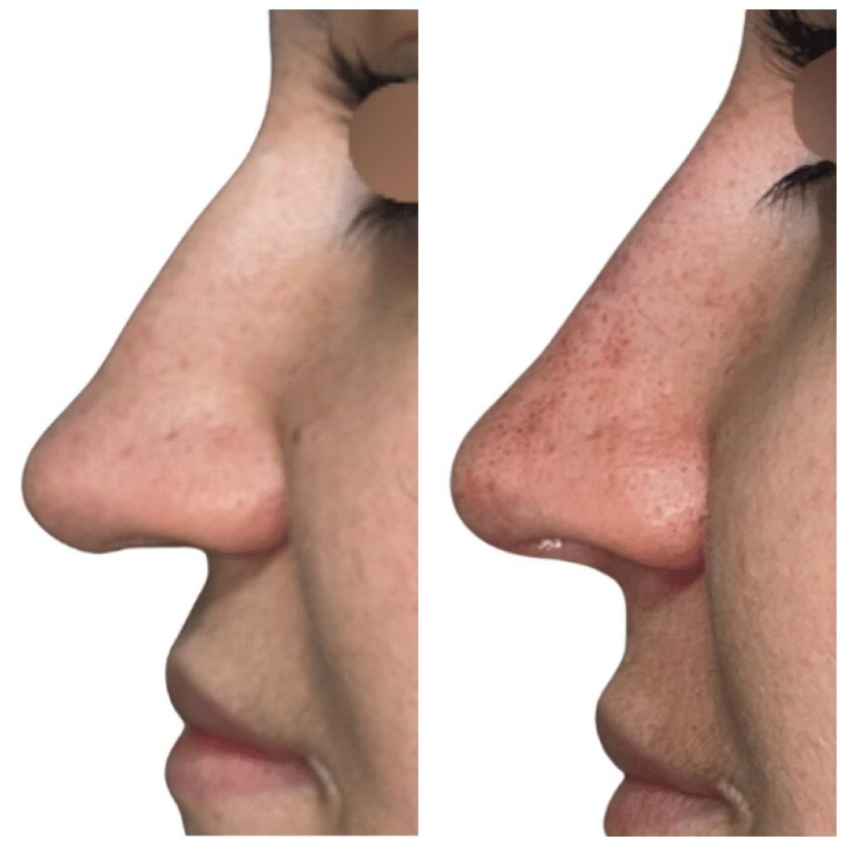 Resultados de rinoplastia antes y después en Michaël Benoilid Plastic and Cosmetic Surgeon Paris France