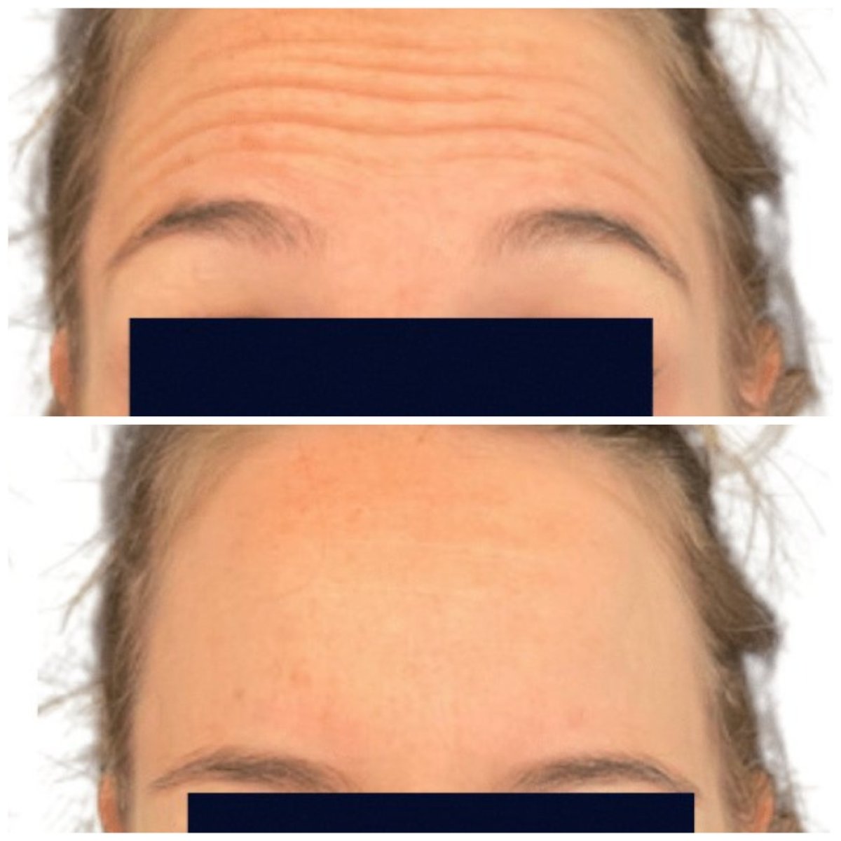 Resultados antes y después de botox para arrugas en la frente en Michaël Benoilid Paris